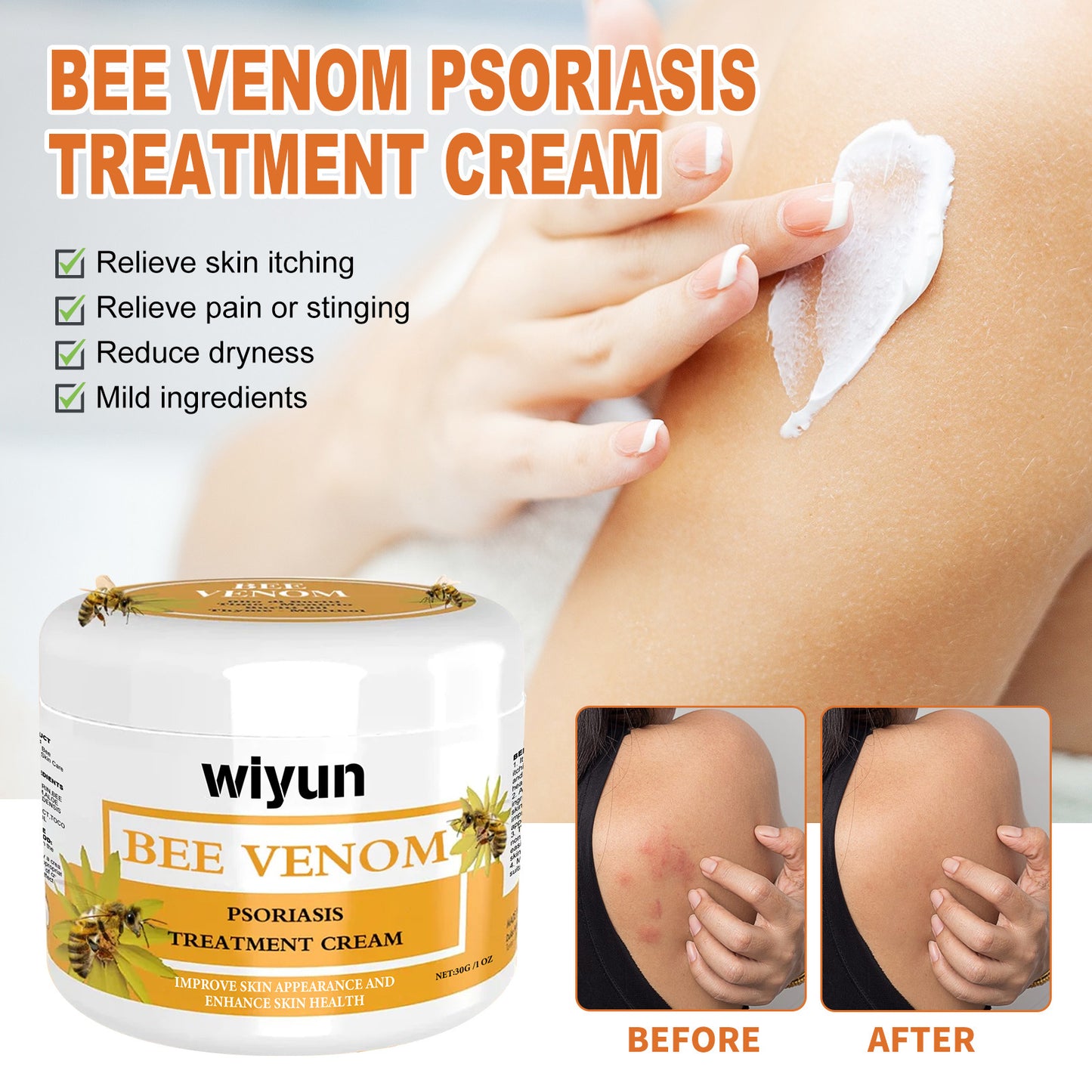 WIYUN Bee Venom Psoriasis Cream Repairs red and itchy skin on hands and feet, moisturizes and smoothes skin care cream 